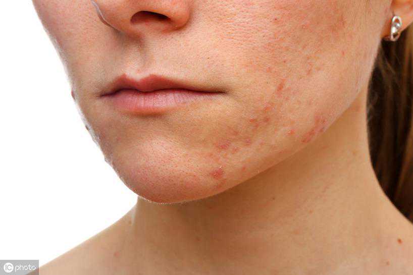 痤疮按照严重程度分4级，不同症状用药建议，收藏