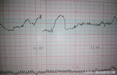 准妈妈必学，一眼教你看懂B超单，判断男女，必须收藏！