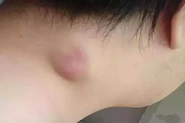 这些小疙瘩暗示肿瘤来临，赶紧看看！为您的健康快收藏！