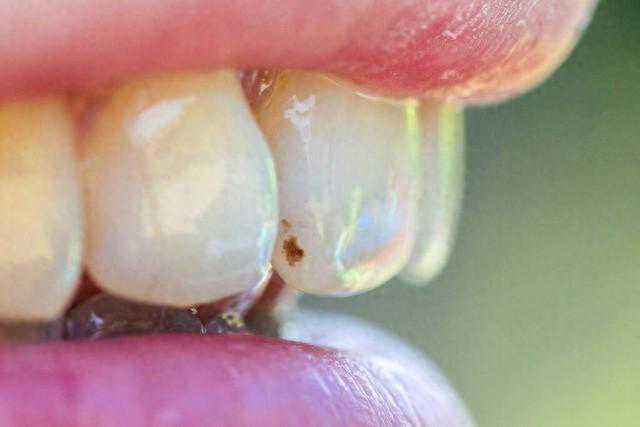 如何清除牙菌斑？不要忽视牙齿健康，速度学起来！建议收藏！