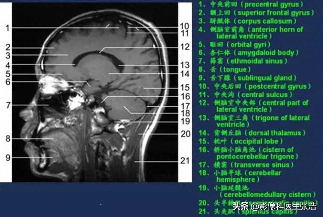 头部磁共振断层（横矢冠状面）图像，附带解剖标注，收藏学习
